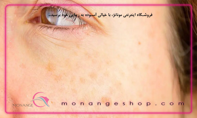 لک های پوست