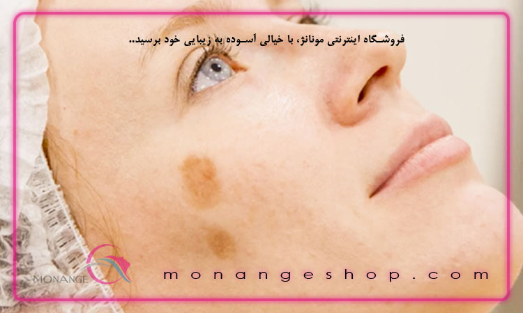 لکه ناگهانی