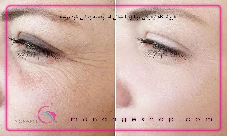 رفع چروک دور چشم