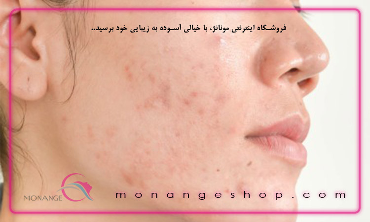 اهمیت استفاده از محصولات غیرکمدوژنیک