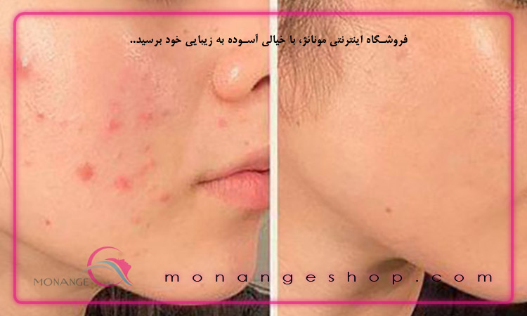 درمان های خانگی در پیشگیری از جوش و آکنه