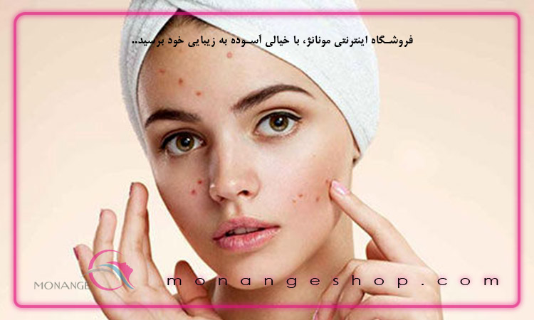 چگونه از جوش و آکنه جلوگیری کنیم