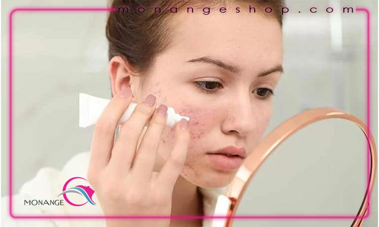 تاثیر ضد آفتاب بر جوش صورت