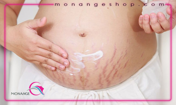 کاهش ترک های پوستی